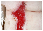 Granulating wound