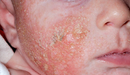 Atopic eczema