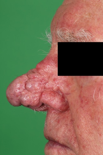 Rhinophyma