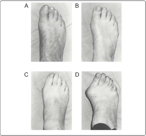 Feet showing progression of Halux Valgus through 4 stages A to D of the Manchester Scale