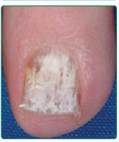 Fungal nail infection