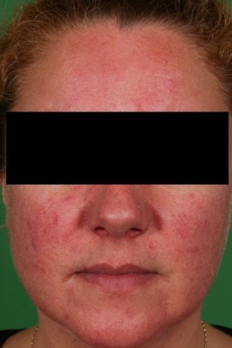 Rosacea